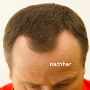 COVER HAIR Haarverdichtung Mit Schütthaar Mittelbraun 14