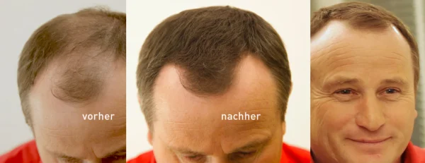 COVER HAIR Haarverdichtung Mit Schütthaar Mittelbraun 6